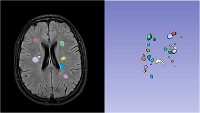Neuroimaging characterization of multiple sclerosis lesions in pediatric patients: an exploratory radiomics approach